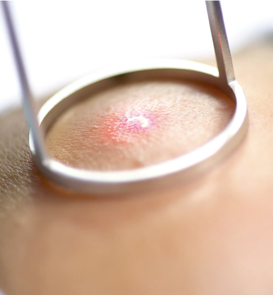 laser co2 treatment on skin